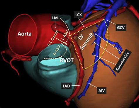 lv summit ablation|left ventricular summit arrhythmia ablation.